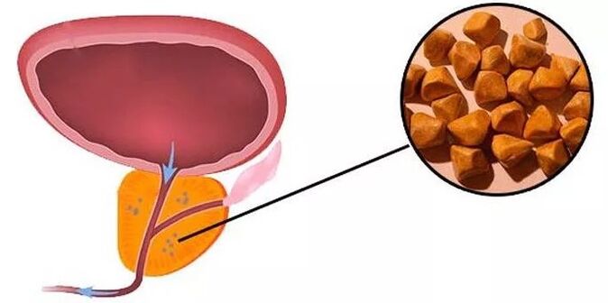 Kamni za prostate